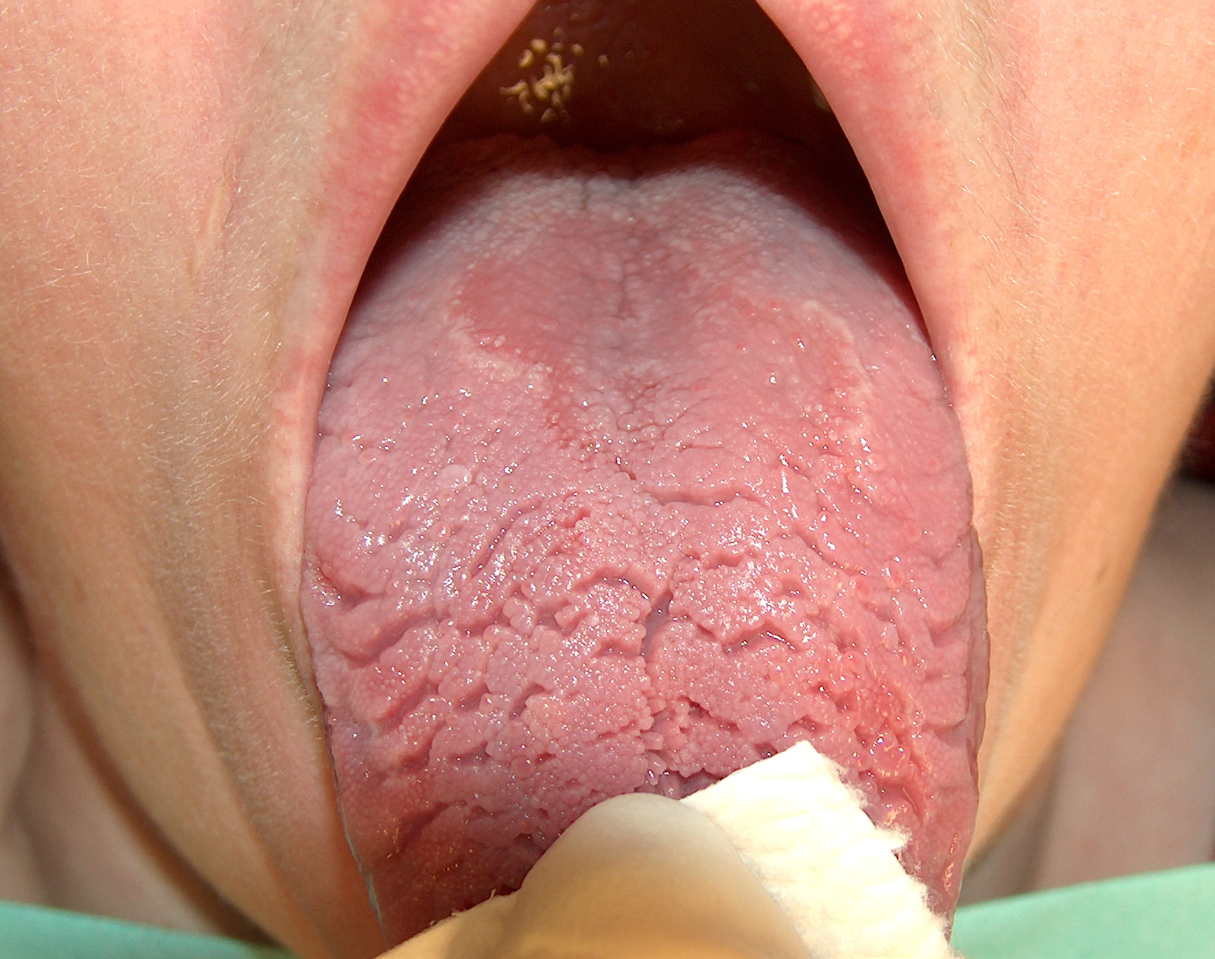 fissured-geographic-tongue